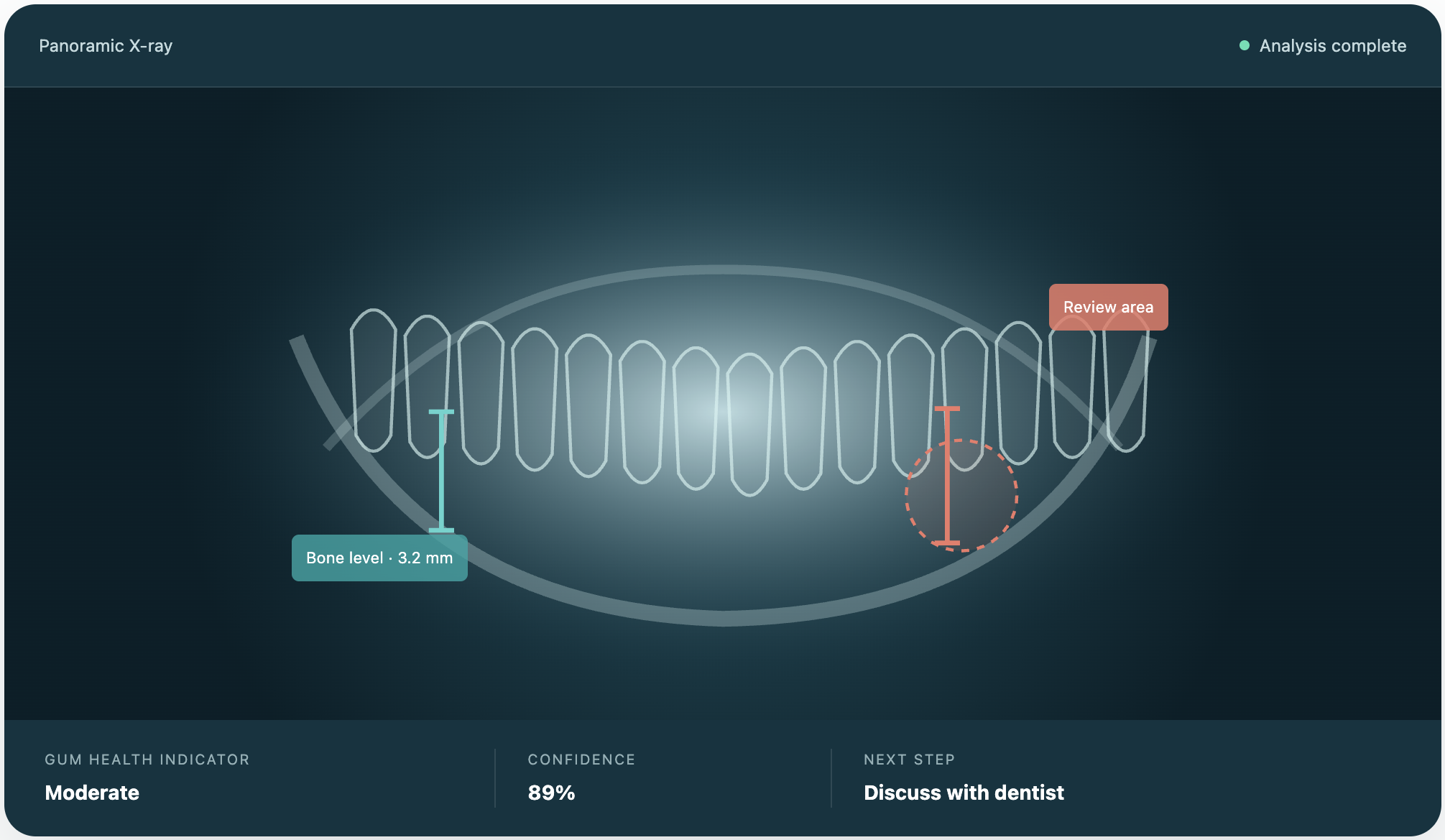 Perio ai analysis screen — panoramic X-ray with bone level, gum health indicator, confidence score, and next step, with disclaimer: AI-assisted insights for education and communication, not a replacement for professional diagnosis or treatment decisions.